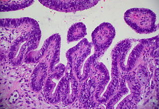 Photo of Papillomavirus e tumore della cervice uterina